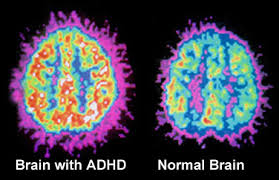 ADHDbrain